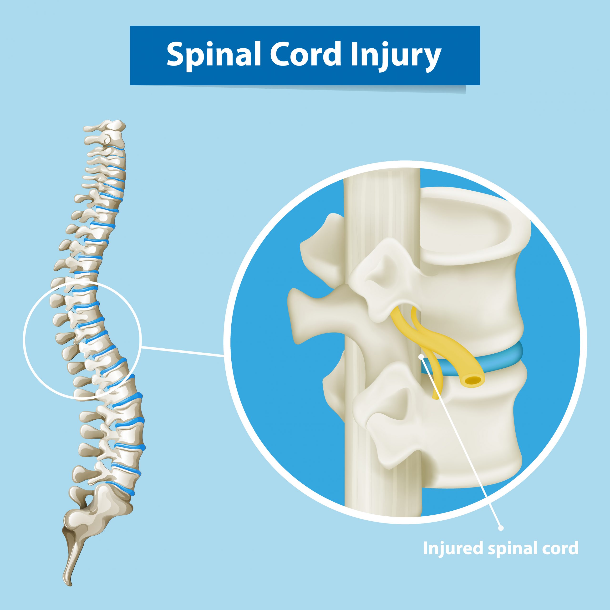 Diagram showing spinal cord injury